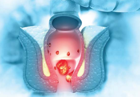 Các bước tầm soát ung thư ống hậu môn